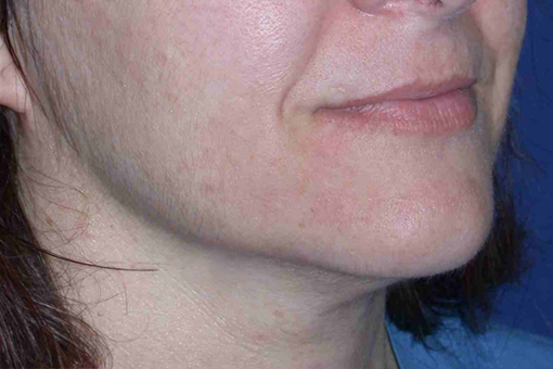 NON-SURGICAL FACE LIFT - Patient 2 - After NON-SURGICAL FACE LIFT - Patient 2 - After